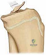 صورة توضيحية لآلية كسر شوكة الظنبوب