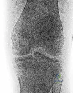 تصنيف مايرز ومكيفير لكسور شوكة الظنبوب