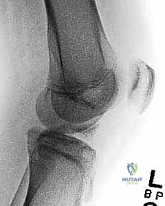 أسباب إصابات الركبة عند الأطفال والرياضيين