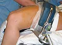 الأعراض السريرية وتورم الركبة بعد الإصابة