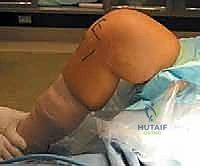 تقييم الخيارات العلاجية لكسور الركبة