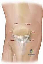 صورة توضيحية لـ كسر شوكة الظنبوب عند الأطفال: دليل شامل للآباء والعلاج المتخصص في صنعاء