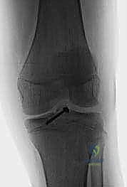 صورة توضيحية لـ كسر شوكة الظنبوب عند الأطفال: دليل شامل للآباء والعلاج المتخصص في صنعاء