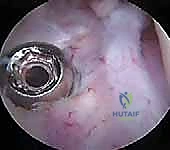 صورة توضيحية لـ كسر شوكة الظنبوب عند الأطفال: دليل شامل للآباء والعلاج المتخصص في صنعاء