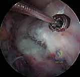 صورة توضيحية لـ كسر شوكة الظنبوب عند الأطفال: دليل شامل للآباء والعلاج المتخصص في صنعاء