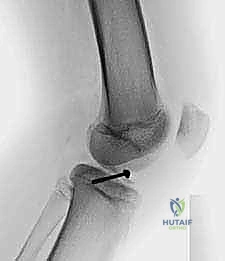 صورة توضيحية لـ كسر شوكة الظنبوب عند الأطفال: دليل شامل للآباء والعلاج المتخصص في صنعاء