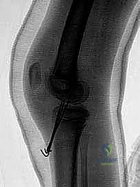 صورة توضيحية لـ كسر شوكة الظنبوب عند الأطفال: دليل شامل للآباء والعلاج المتخصص في صنعاء