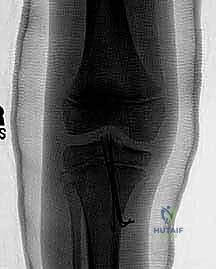 صورة توضيحية لـ كسر شوكة الظنبوب عند الأطفال: دليل شامل للآباء والعلاج المتخصص في صنعاء