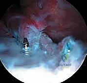 صورة توضيحية لـ كسر شوكة الظنبوب عند الأطفال: دليل شامل للآباء والعلاج المتخصص في صنعاء