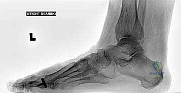 جراحة مفصل إبهام القدم الصناعي الجزئي (BioPro) لعلاج التهاب مفصل إصبع القدم الكبير: دليل شامل من الأستاذ الدكتور محمد هطيف