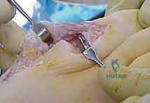Illustration of metatarsophalangeal joint hemiarthroplasty - Dr. Mohammed Hutaif