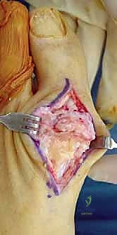 تفاصيل غرسة BioPro في جراحة مفصل إبهام القدم