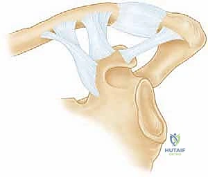 Illustration of nonarticular scapular fractures - Dr. Mohammed Hutaif