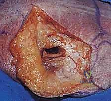 صورة تظهر التخطيط الجراحي لكسر الكتف العائم