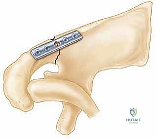 صورة توضح النهج الجراحي والشق المستخدم