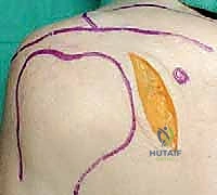 صورة تظهر وضع الشرائح والمسامير بدقة عالية