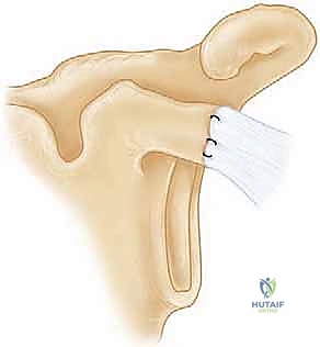 صورة أشعة ما بعد الجراحة تظهر التثبيت المثالي