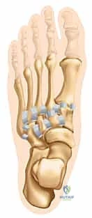 تقييم حالة ليزفرانك مع الدكتور محمد هطيف في صنعاء