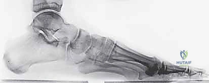 صورة رنين مغناطيسي تظهر تمزق رباط ليزفرانك