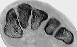 تفاصيل الأشعة السينية لمفصل ليزفرانك