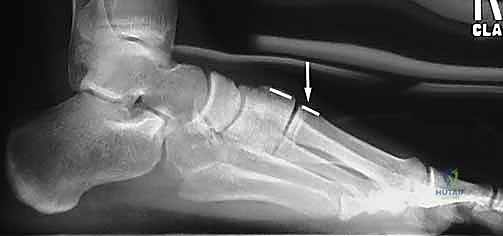 الكدمات الأخمصية - العلامة المميزة لإصابة ليزفرانك