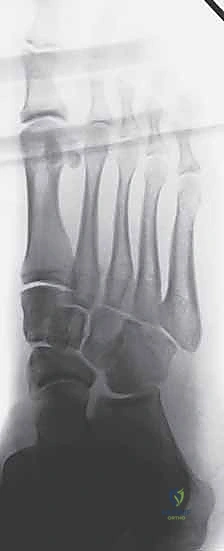 صورة مقطعية محوسبة (CT Scan) تظهر تفاصيل الكسر