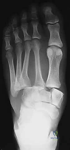 تقسيم أعمدة القدم الثلاثة في التخطيط الجراحي