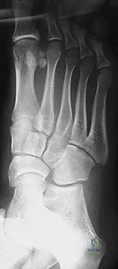 توضيح أنماط تصنيف إصابات ليزفرانك