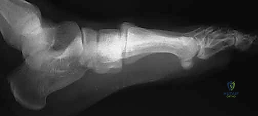 آثار الإصابة المباشرة عالية الطاقة على القدم