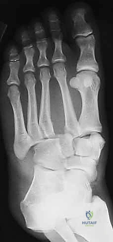 آلية الإصابة غير المباشرة في الرياضة