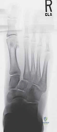 صورة أشعة سينية تظهر اتساع المسافة بين الأمشاط