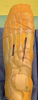 صورة توضيحية لـ إصابة ليزفرانك: دليل شامل للتشخيص والعلاج الجراحي الدقيق في صنعاء مع الأستاذ الدكتور محمد هطيف