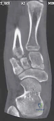 تطبيق جبيرة طبية للعلاج التحفظي