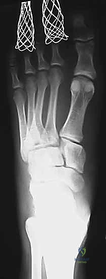 إصابة ليزفرانك: دليل شامل للتشخيص والعلاج الجراحي الدقيق في صنعاء مع الأستاذ الدكتور محمد هطيف