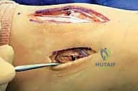 صورة طبية: إصابة ليزفرانك: دليل شامل للتشخيص والعلاج الجراحي الدقيق في صنعاء مع الأستاذ الدكتور محمد هطيف