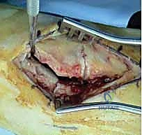 صورة توضيحية لـ إصابة ليزفرانك: دليل شامل للتشخيص والعلاج الجراحي الدقيق في صنعاء مع الأستاذ الدكتور محمد هطيف