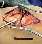 صورة طبية: إصابة ليزفرانك: دليل شامل للتشخيص والعلاج الجراحي الدقيق في صنعاء مع الأستاذ الدكتور محمد هطيف