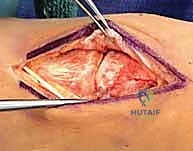 صورة توضيحية لـ إصابة ليزفرانك: دليل شامل للتشخيص والعلاج الجراحي الدقيق في صنعاء مع الأستاذ الدكتور محمد هطيف