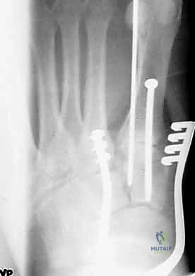 صورة توضيحية لـ إصابة ليزفرانك: دليل شامل للتشخيص والعلاج الجراحي الدقيق في صنعاء مع الأستاذ الدكتور محمد هطيف