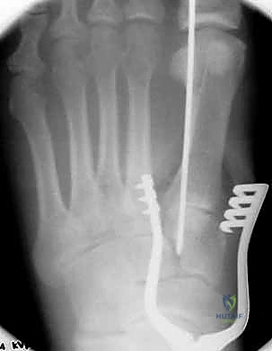 صورة توضيحية لـ إصابة ليزفرانك: دليل شامل للتشخيص والعلاج الجراحي الدقيق في صنعاء مع الأستاذ الدكتور محمد هطيف