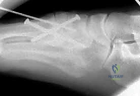 صورة طبية: إصابة ليزفرانك: دليل شامل للتشخيص والعلاج الجراحي الدقيق في صنعاء مع الأستاذ الدكتور محمد هطيف