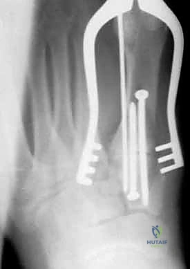 صورة طبية: إصابة ليزفرانك: دليل شامل للتشخيص والعلاج الجراحي الدقيق في صنعاء مع الأستاذ الدكتور محمد هطيف