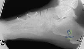 توضيح شكل القوس الروماني في عظام القدم