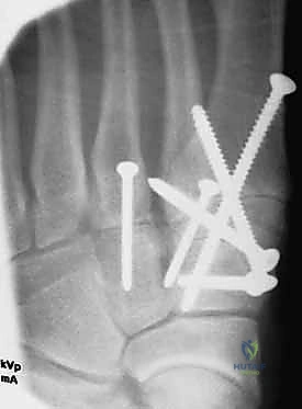 صورة طبية: إصابة ليزفرانك: دليل شامل للتشخيص والعلاج الجراحي الدقيق في صنعاء مع الأستاذ الدكتور محمد هطيف