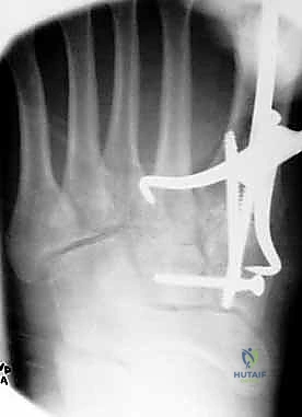صورة توضيحية لـ إصابة ليزفرانك: دليل شامل للتشخيص والعلاج الجراحي الدقيق في صنعاء مع الأستاذ الدكتور محمد هطيف