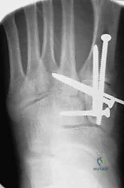 مسمار ليزفرانك يمر من العظم المسماري للمشط الثاني