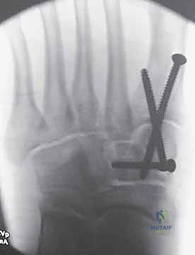 تمزق رباط ليزفرانك وفقدان الاستقرار