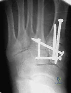 صورة طبية: إصابة ليزفرانك: دليل شامل للتشخيص والعلاج الجراحي الدقيق في صنعاء مع الأستاذ الدكتور محمد هطيف