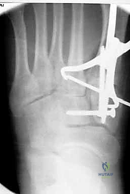 صورة طبية: إصابة ليزفرانك: دليل شامل للتشخيص والعلاج الجراحي الدقيق في صنعاء مع الأستاذ الدكتور محمد هطيف