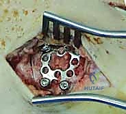 توضيح طبي لآلية إصابة ليزفرانك في منتصف القدم